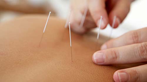 Medical Acupuncture