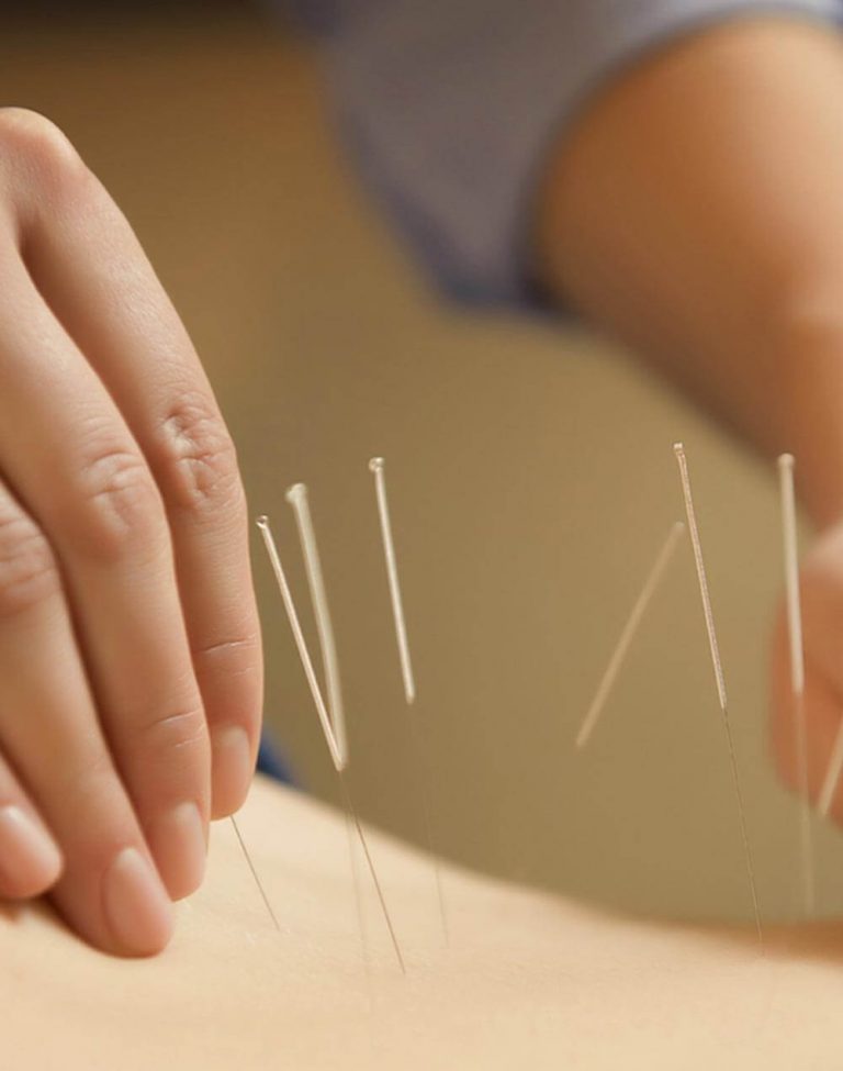 Acupuncture BodyWise Chiropractic Tempe